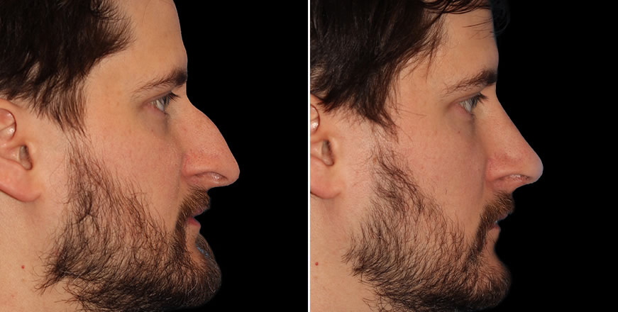 Atlanta Georgia Scarless Nose Surgery Results Side View